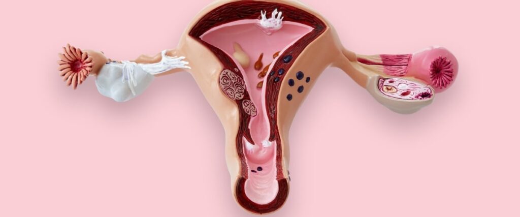 Endometrioza może przybierać różne postaci