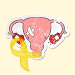 Endometrioza – co to takiego?