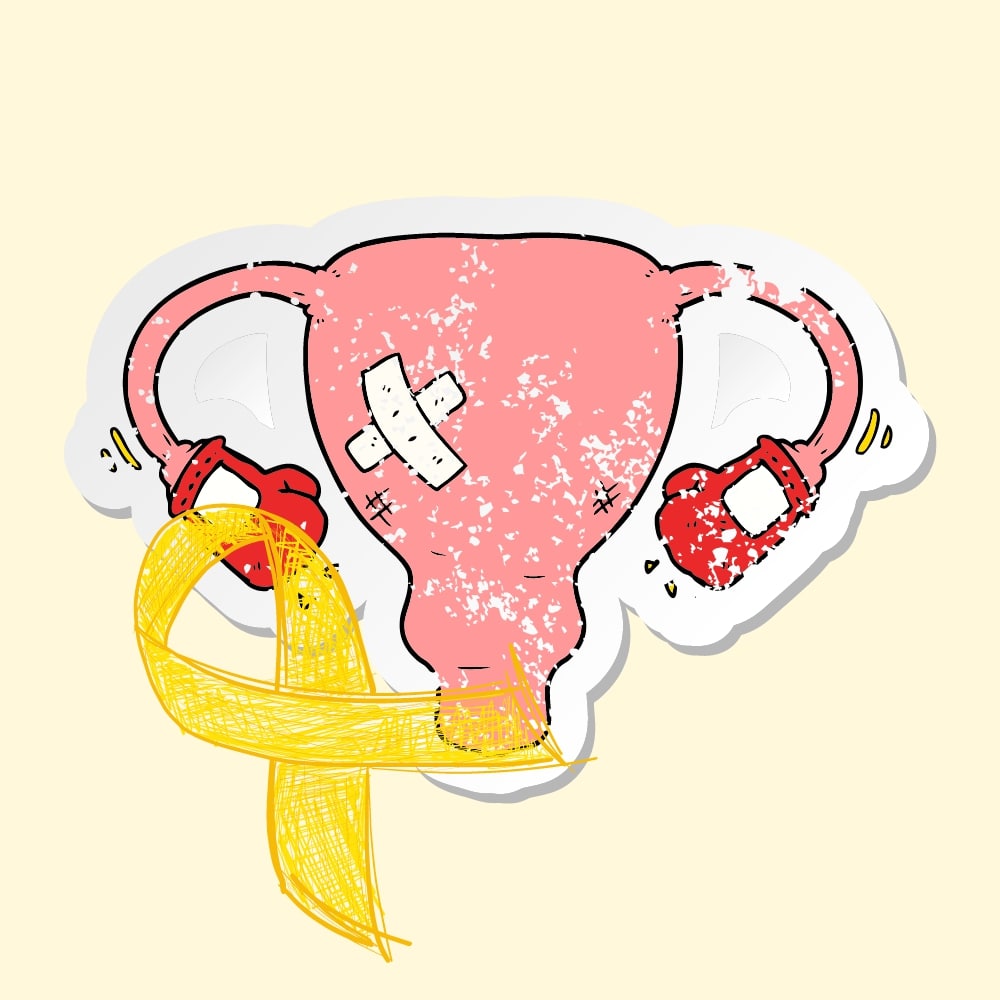Endometrioza Objawy Przyczyny Powikania I Leczenie 9685